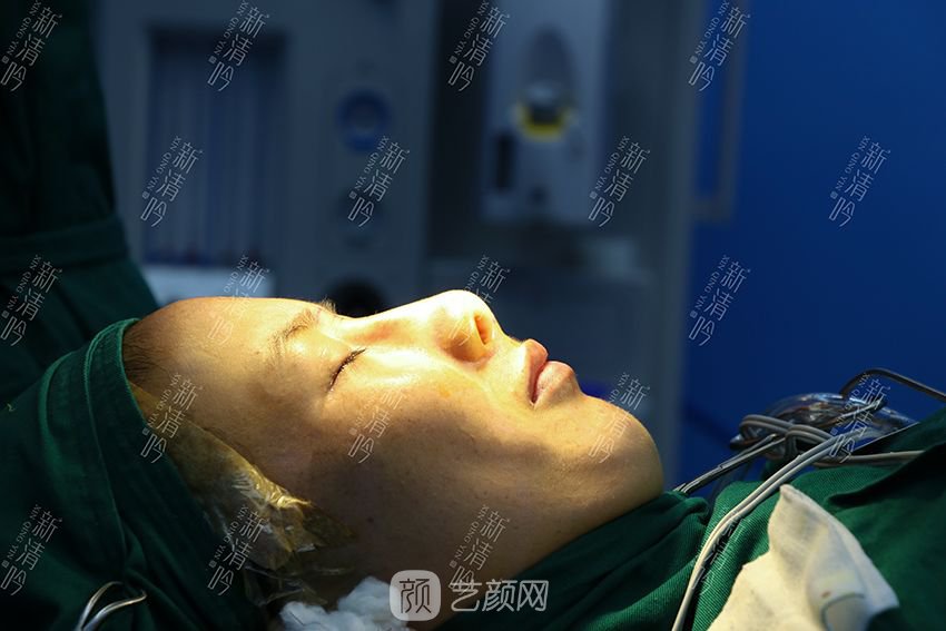 耳軟骨隆鼻果圖分享，術(shù)后~