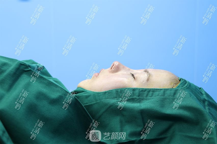 耳軟骨隆鼻果圖分享，術(shù)后~