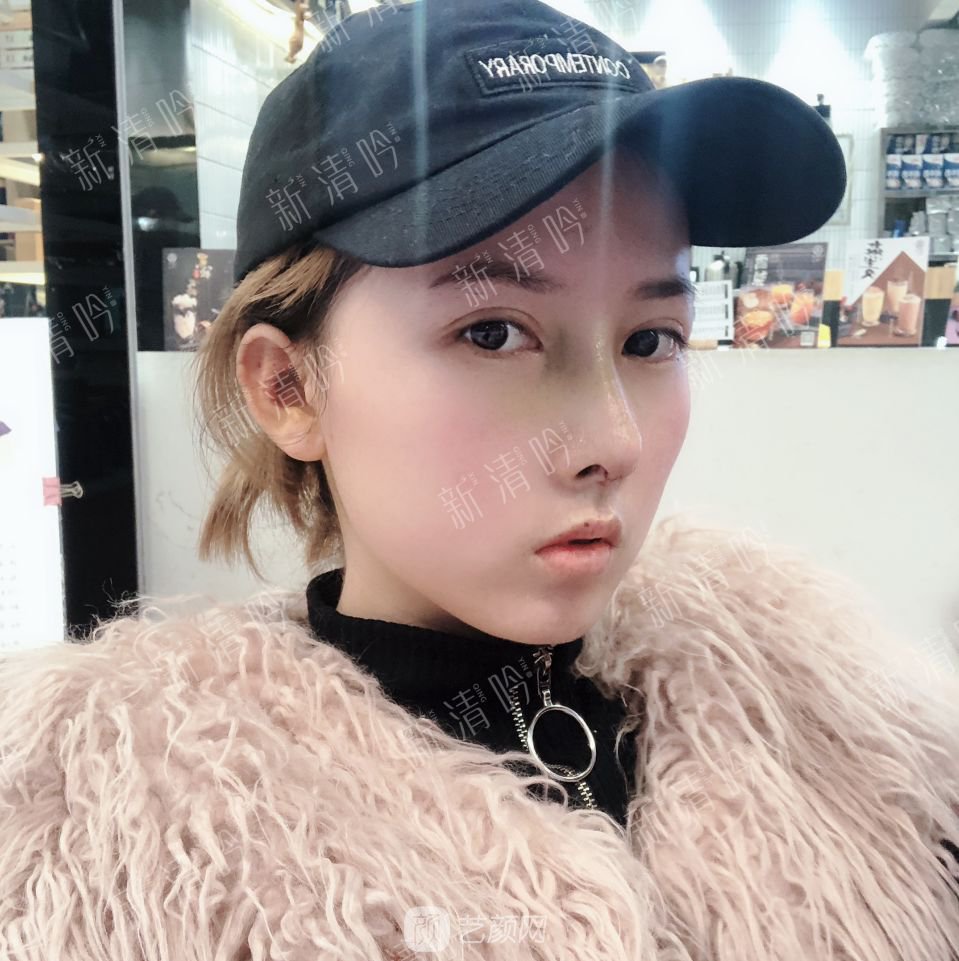 耳軟骨綜合隆鼻半個月了，分享恢復(fù)果照片~