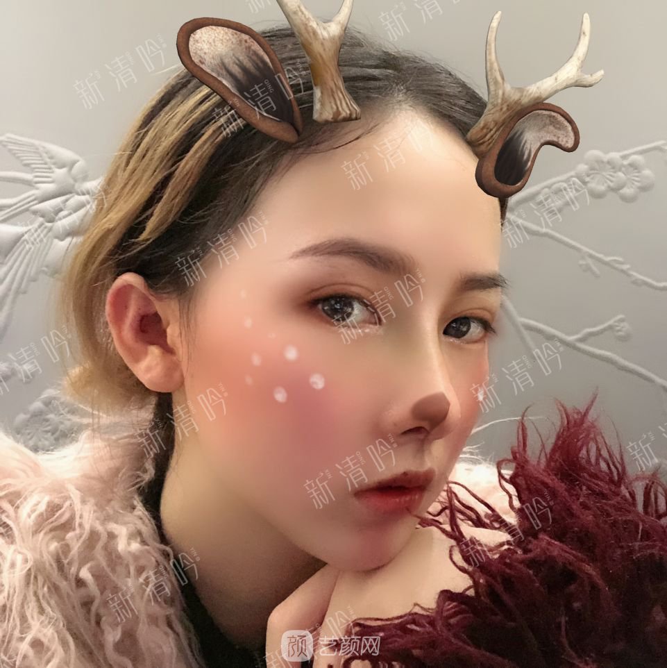 耳軟骨綜合隆鼻半個月了，分享恢復(fù)果照片~