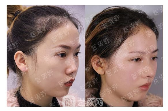 耳軟骨綜合隆鼻半個月了，分享恢復(fù)果照片~