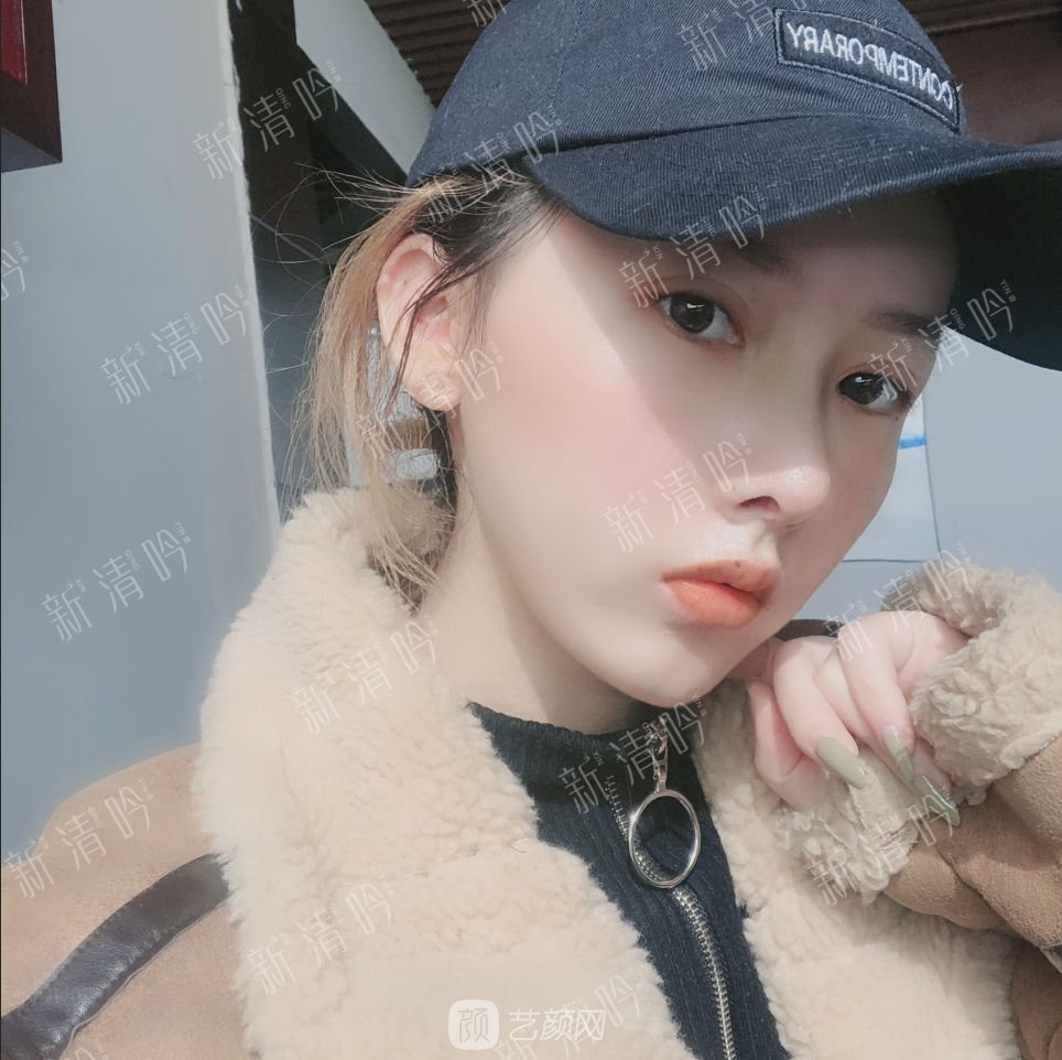 耳軟骨綜合隆鼻半個月了，分享恢復(fù)果照片~