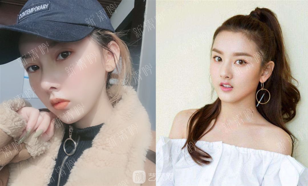 耳軟骨綜合隆鼻半個月了，分享恢復(fù)果照片~