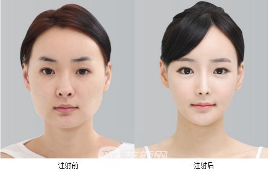 注射瘦臉注射瘦臉多少錢