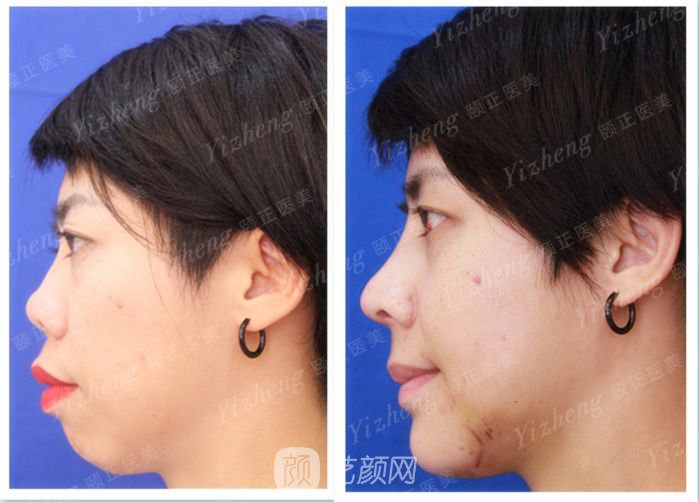 自體肋軟骨隆鼻+假體隆下頜一個(gè)月果照片分享~