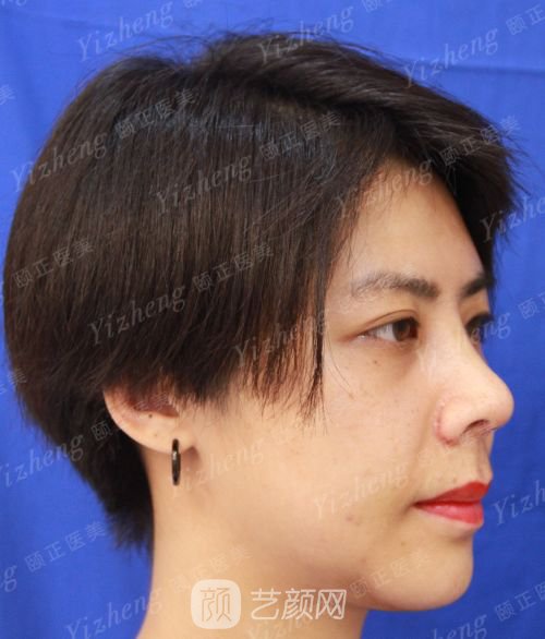 自體肋軟骨隆鼻+假體隆下頜一個(gè)月果照片分享~