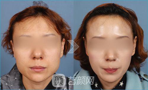 【北京磨腮骨大概多少錢?】