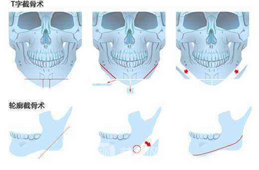 【北京磨腮骨大概多少錢?】