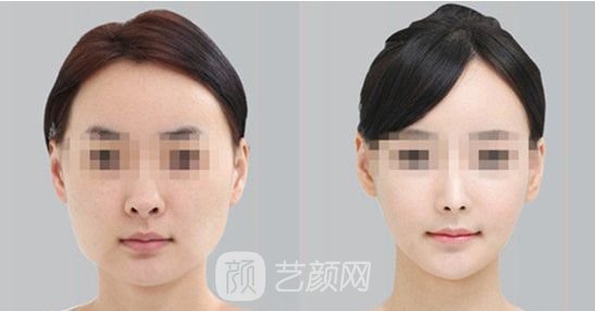 【北京磨腮骨大概多少錢?】