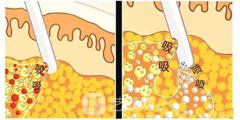 沈陽(yáng)水動(dòng)力吸脂價(jià)格多少？