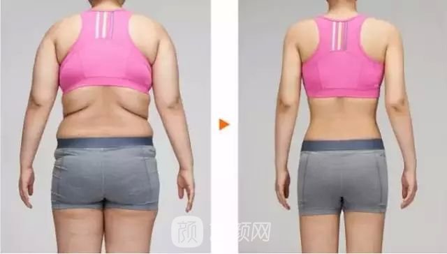 沈陽(yáng)水動(dòng)力吸脂價(jià)格多少？