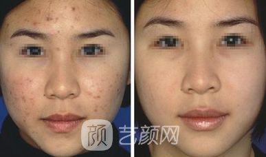 像素激光祛痘大概多少錢(qián)?