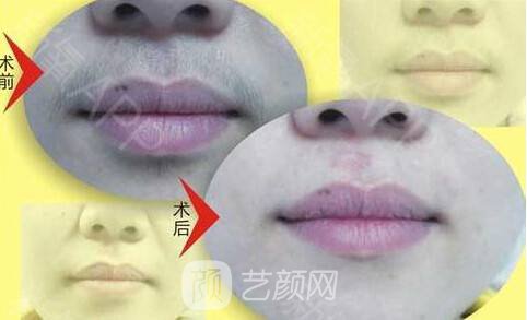 萊西爾脫毛是什么?萊西爾脫毛有什么優(yōu)勢?