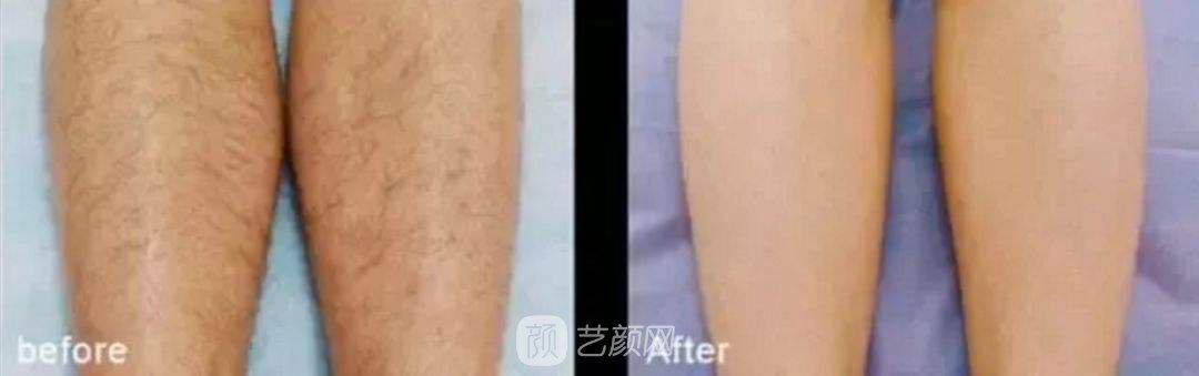 萊西爾脫毛是什么?萊西爾脫毛有什么優(yōu)勢?