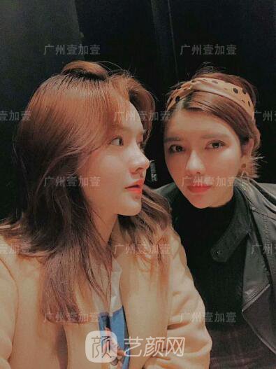 廣州壹加壹假體隆鼻修復圖