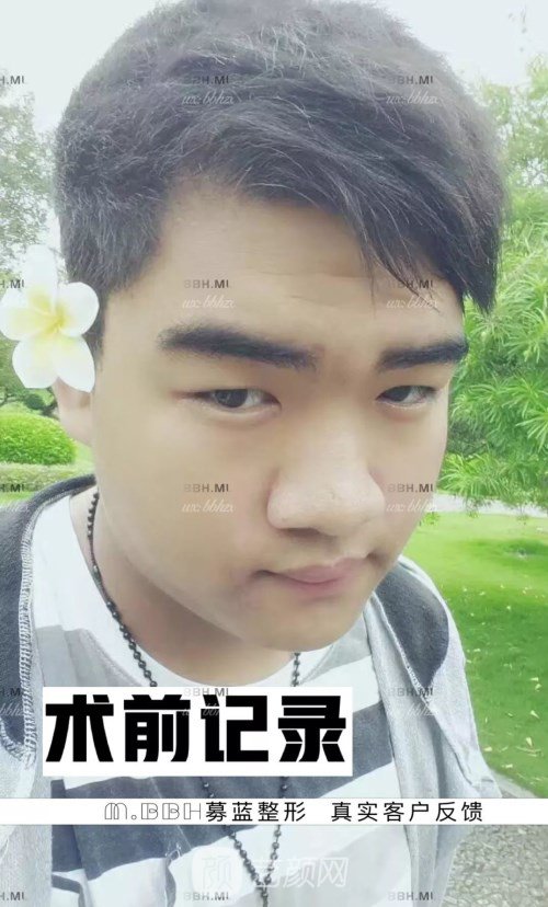 眼部手術(shù)案例——昆明募藍術(shù)后一年果照片分享~