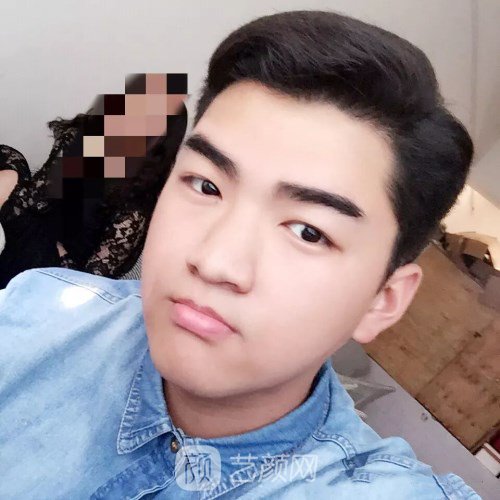 眼部手術(shù)案例——昆明募藍術(shù)后一年果照片分享~