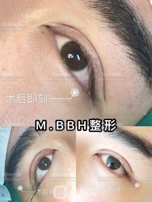 眼部手術(shù)案例——昆明募藍術(shù)后一年果照片分享~