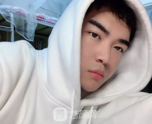 眼部手術(shù)案例——昆明募藍術(shù)后一年果照片分享~