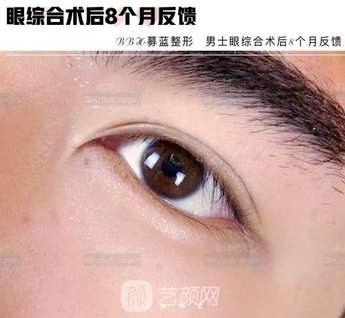眼部手術(shù)案例——昆明募藍術(shù)后一年果照片分享~
