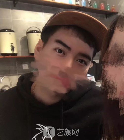 眼部手術(shù)案例——昆明募藍術(shù)后一年果照片分享~