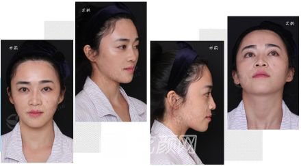 濟(jì)南歪鼻矯正需要多少錢(qián)？