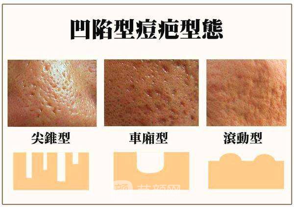 怎么調(diào)節(jié)痘疤比較好?調(diào)節(jié)痘疤有哪些方法?