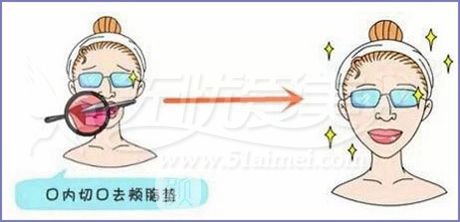 去頰脂墊和吸脂哪個(gè)好?