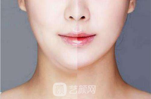 去頰脂墊和吸脂哪個(gè)好?