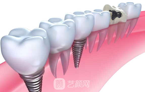 種植牙費(fèi)用多少