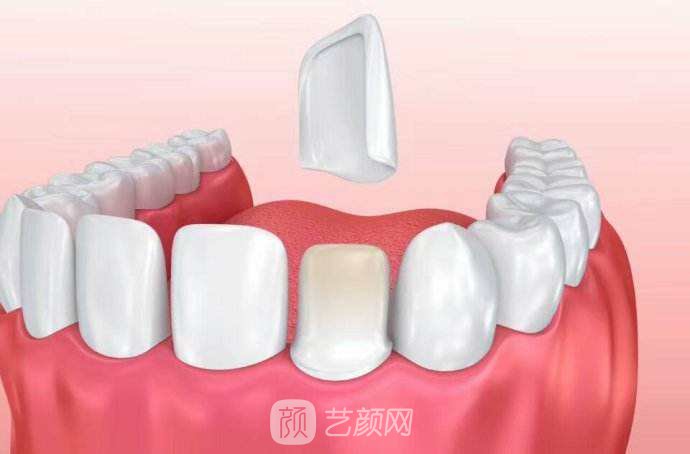 【牙貼面多少錢一顆？】