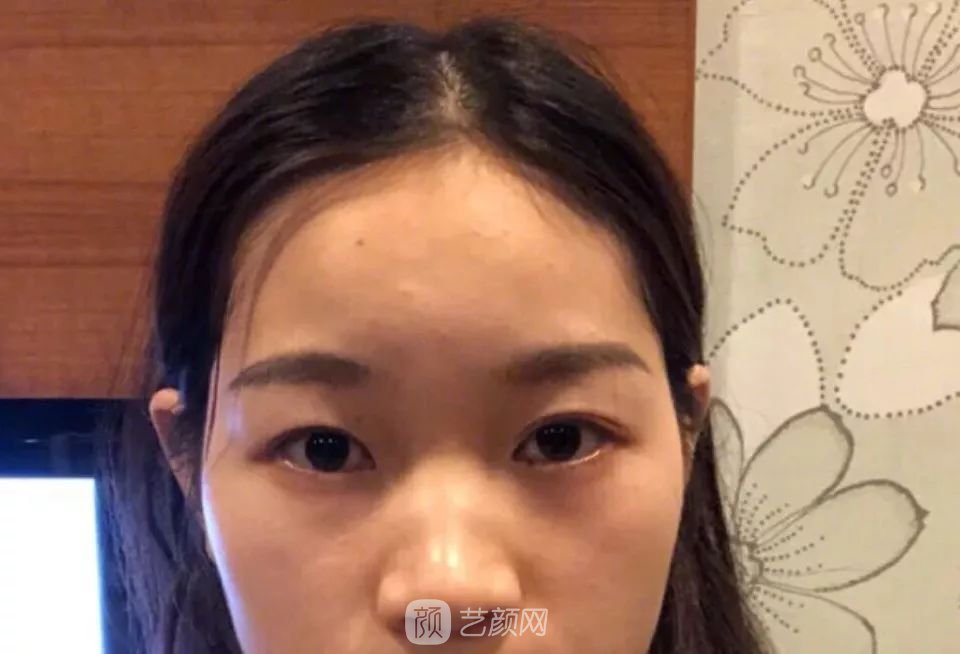 鼻部手術(shù)一個(gè)月恢復(fù)日記分享~