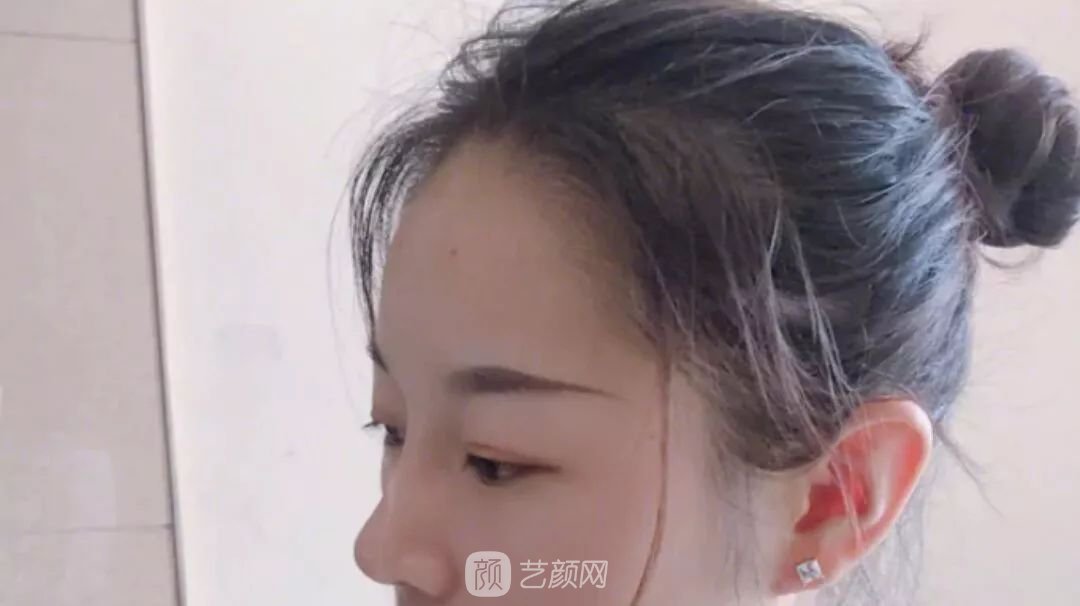 鼻部手術(shù)一個(gè)月恢復(fù)日記分享~