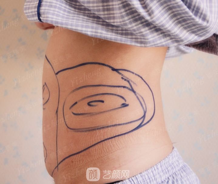 葫蘆島頤正夏秉成鼻部手術(shù)+SVF自體脂肪多方面部填充案例~