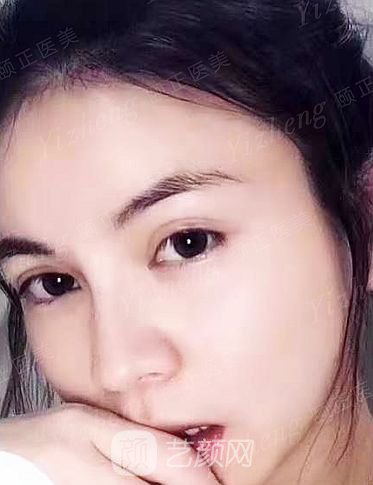 葫蘆島頤正夏秉成鼻部手術(shù)+SVF自體脂肪多方面部填充案例~