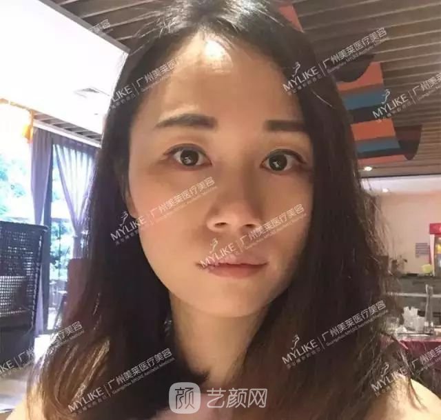 廣州美萊玻尿酸全臉填充果照片分享~