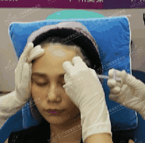 廣州美萊玻尿酸全臉填充果照片分享~