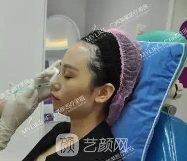 廣州美萊玻尿酸全臉填充果照片分享~