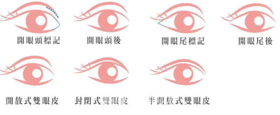 割雙眼皮修復要多少錢