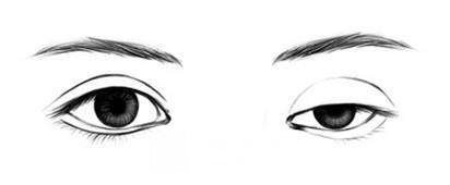 割雙眼皮修復要多少錢