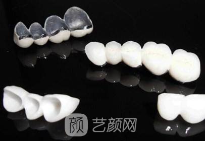 【烤瓷牙植牙多少錢？】