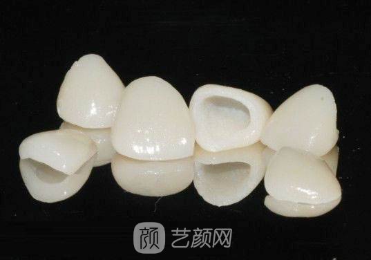 【烤瓷牙植牙多少錢？】