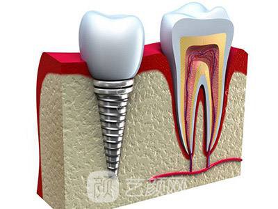 【成都植牙費(fèi)用】