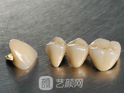 烤瓷牙價(jià)格多少