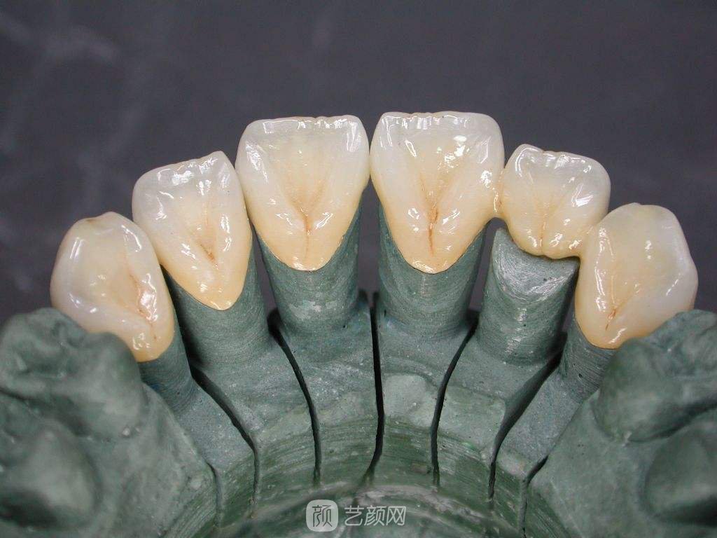 烤瓷牙價(jià)格多少