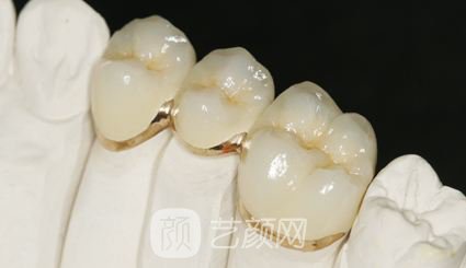 烤瓷牙價(jià)格多少