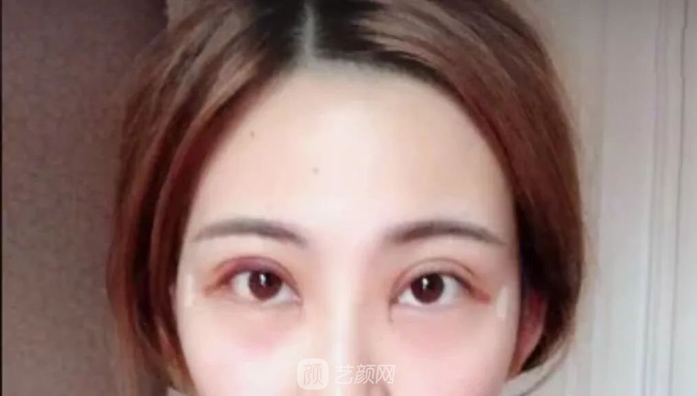 眼部手術(shù)一個月恢復(fù)日記，片分享~