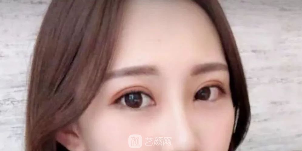 眼部手術(shù)一個月恢復(fù)日記，片分享~