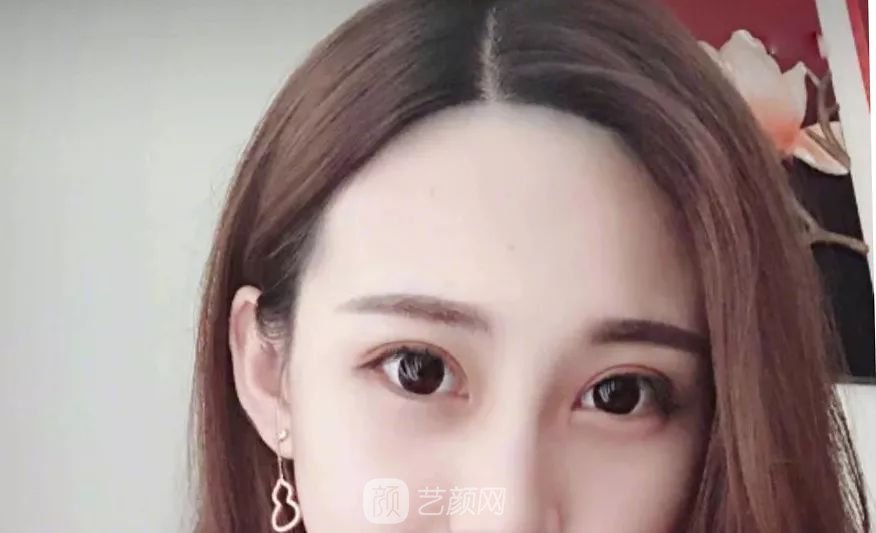 眼部手術(shù)一個月恢復(fù)日記，片分享~