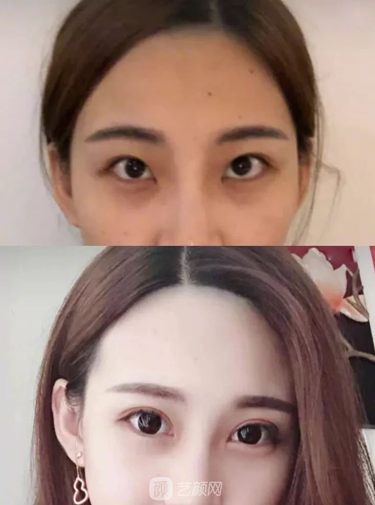 眼部手術(shù)一個月恢復(fù)日記，片分享~